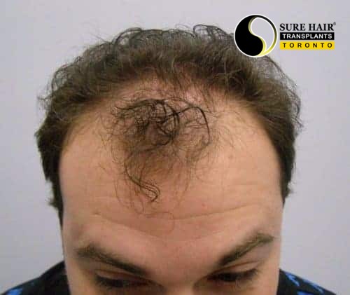 Before FUT hair transplant