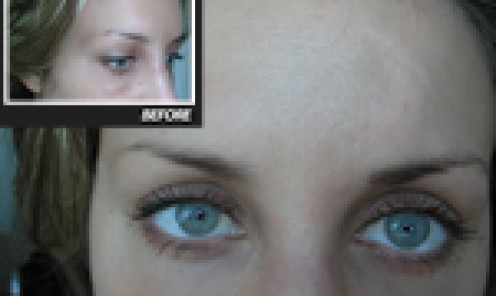 Eyebrow Hair Transplant Client 1