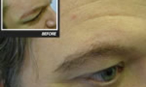 Eyebrow Hair Transplant Client 3