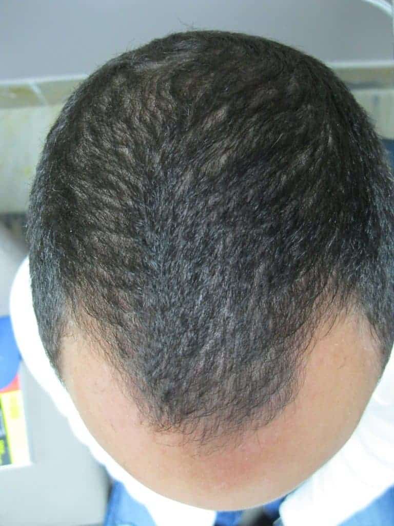 Andrew after 6 Months of laser hair therapy Treatment