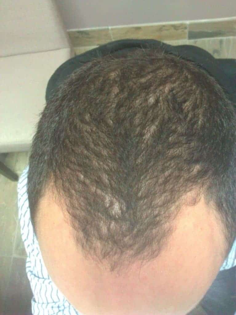 Andrew before 6 Months of laser hair therapy Treatment