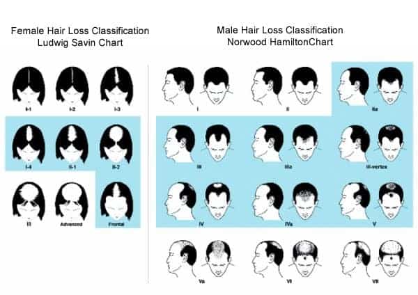 Norwood Hair Loss Scale