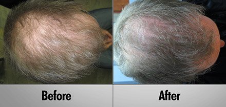 laser hair growth Before and After photos client3