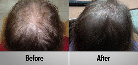 laser hair growth Before and After photos client7