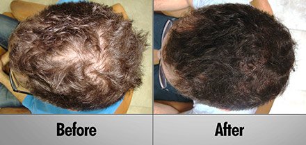 laser hair growth Before and After photos client2