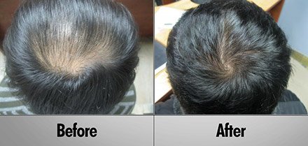 laser hair growth Before and After photos client1