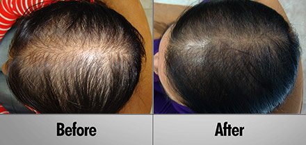 Laser Hair Treatment Before and After photos client6