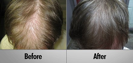 laser hair growth Before and After photos client5