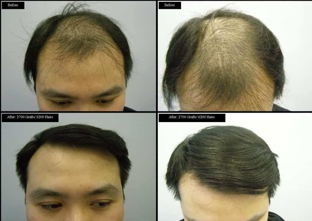 Before and after hair transplant Asian male complete set