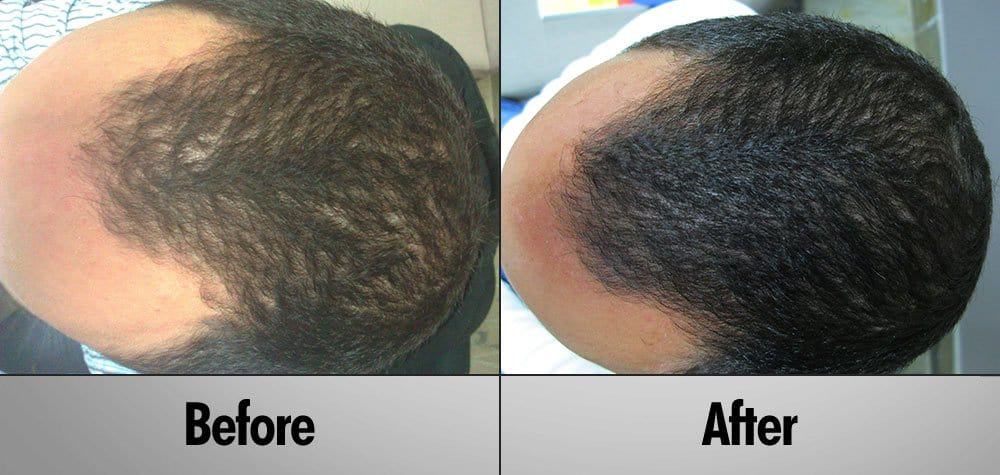 Andrew before-after 6 months of laser hair therapy treatment