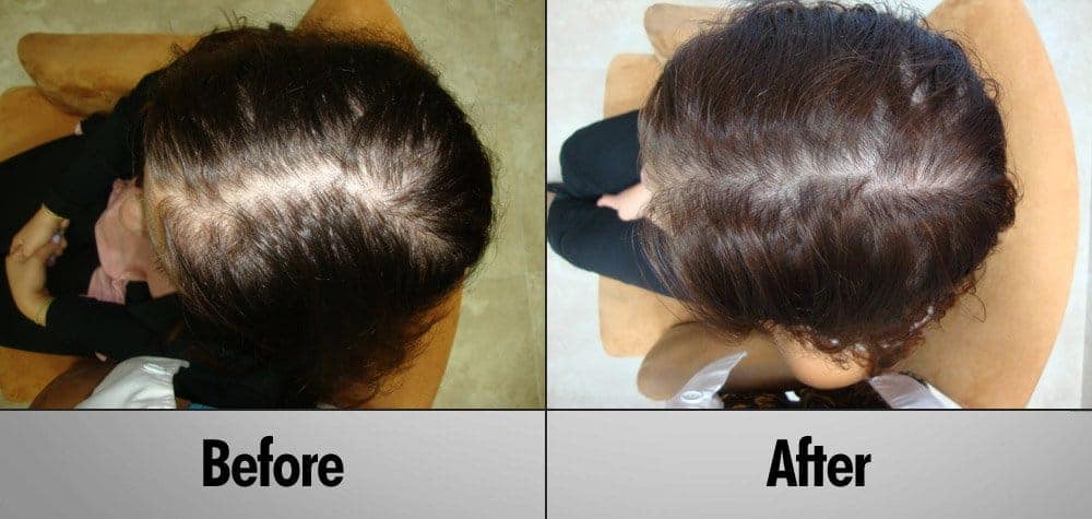Client 12 Before and After 6 Months PRP Treatment