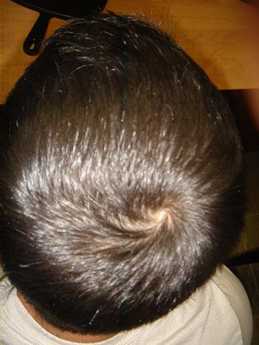 Brad after 9 monts laser hair regrowth treatment