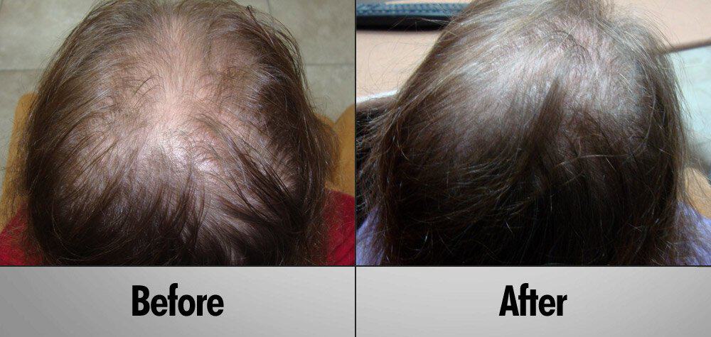 Client 11 Before and After 2 Months PRP Treatment