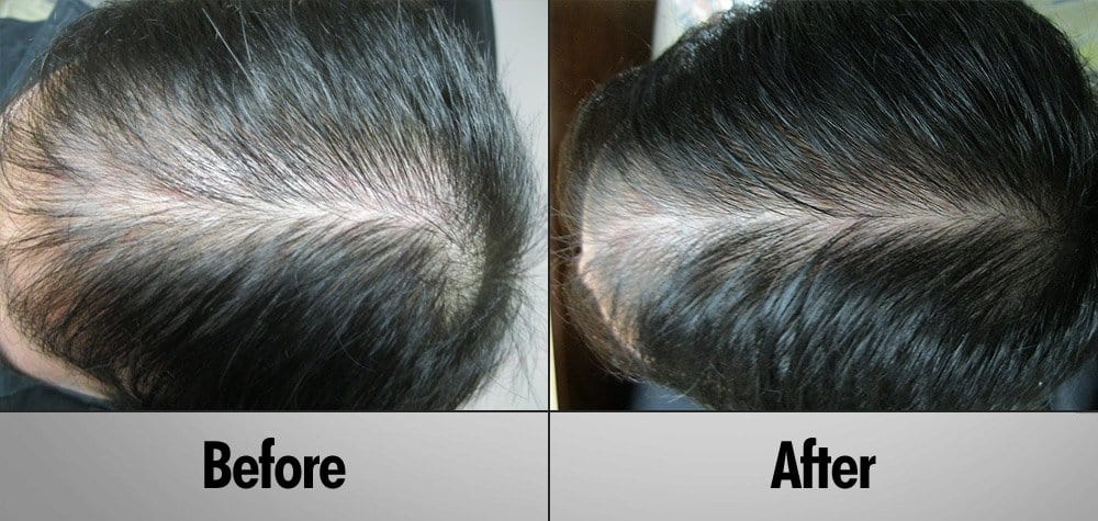 Client 10 Before and After  3 Months  PRP Treatment