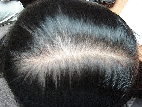 Client 8 Before 2 Months PRP Regrowth Treatment