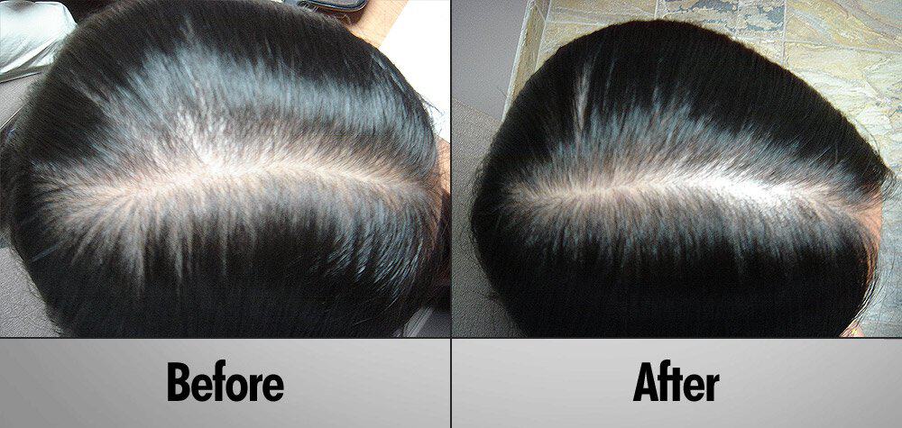 Client 8 Before and After 2 Months PRP Regrowth Treatment