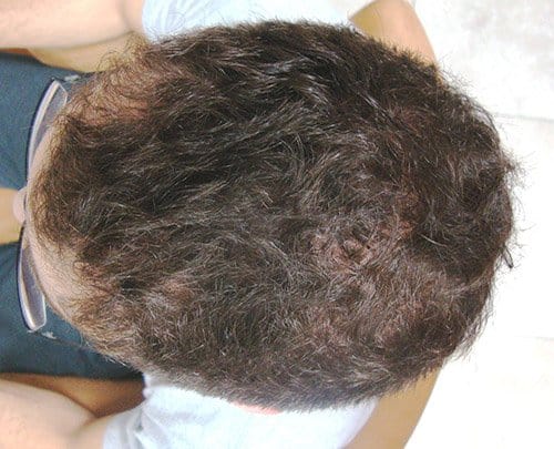 Surehair Patient Matt after 6 months laser hair therapy top of head