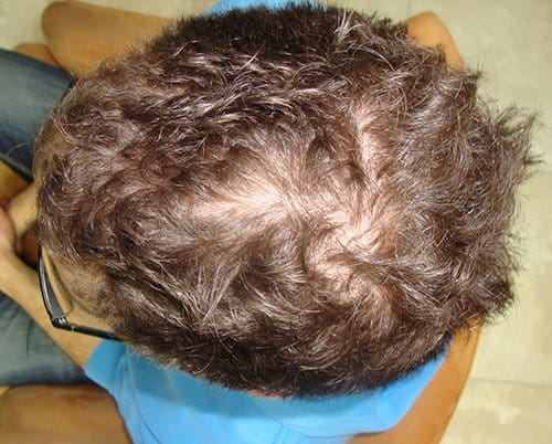 Surehair Patient Matt Before laser hair therapy top of head