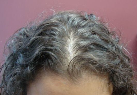 Client 7 Frontal View After PRP Treatment