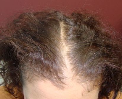 Client 7 Frontal View Before PRP Treatment