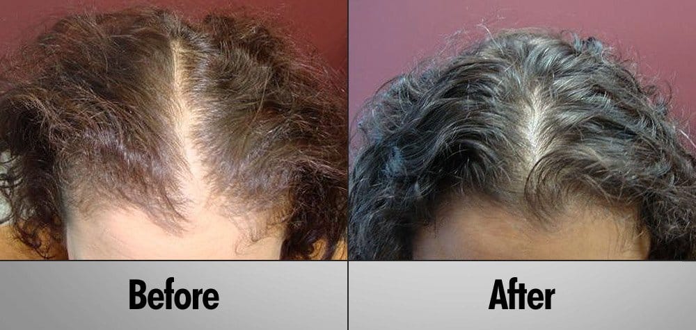 Client 7 Before and After PRP Hair Regrowth Treatment