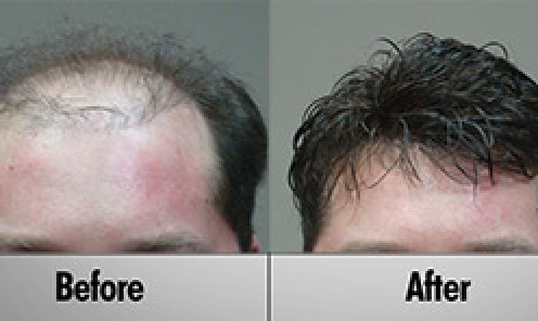Male Hair Replacement - NT Single Strand Hair Insertion
