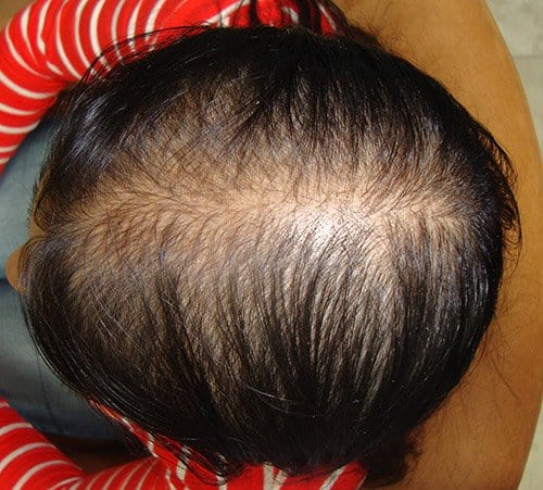 PRP Hair Regrowth Treatment Before Client 4 Crown