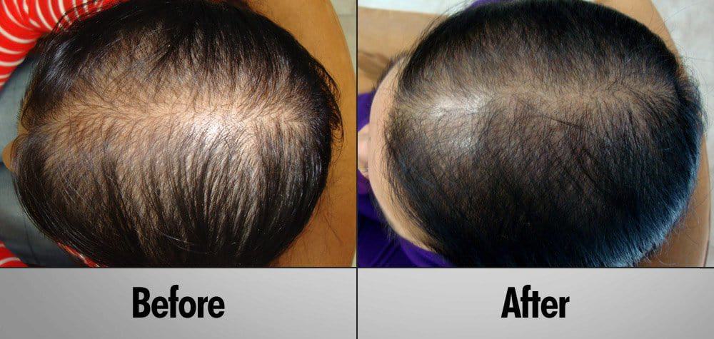 PRP Hair Regrowth Treatment Before and After 6 Months
