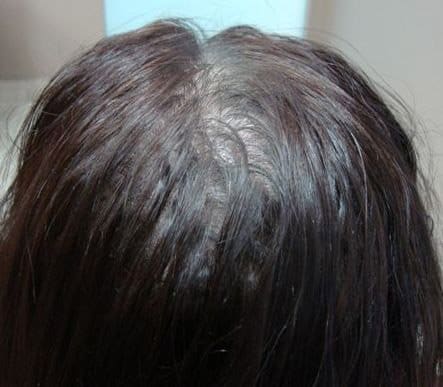 Client 3 PRP Hair Regrowth Treatment After