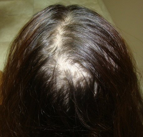 Client 3 PRP Hair Regrowth Treatment Before