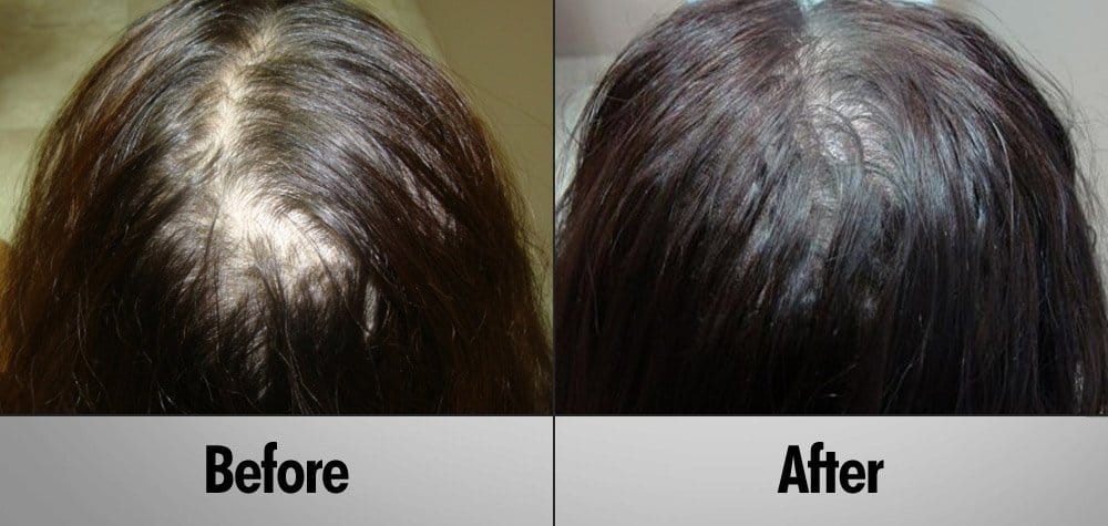 Client 3 PRP Hair Regrowth Treatment Before and After