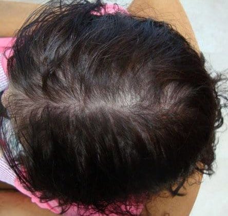 After PRP Hair Regrowth Treatment Top of head