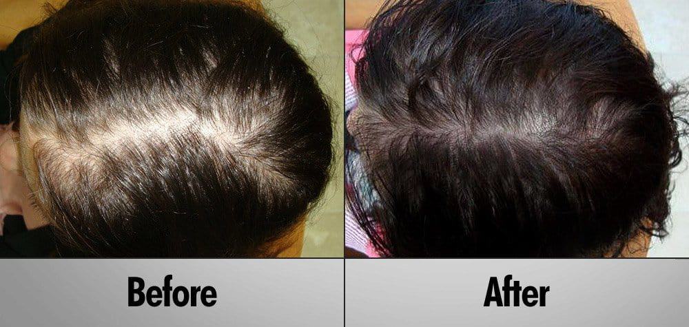 PRP Hair Regrowth Treatment Client 3