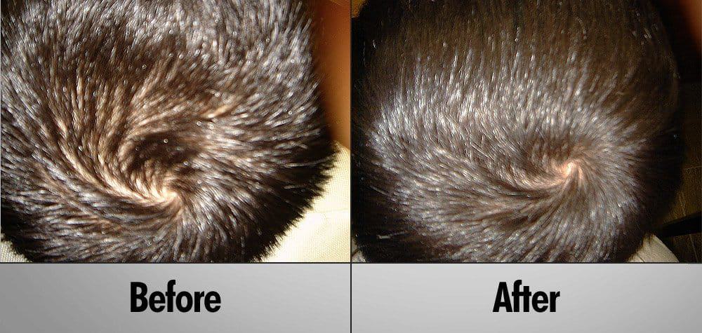 Brad before and after 9-month laser hair regrowth treatment