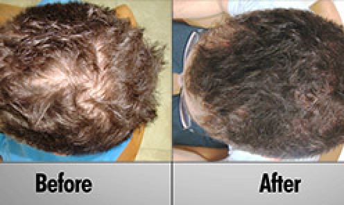 Laser Hair Therapy Hair Regrowth - Patient Matt