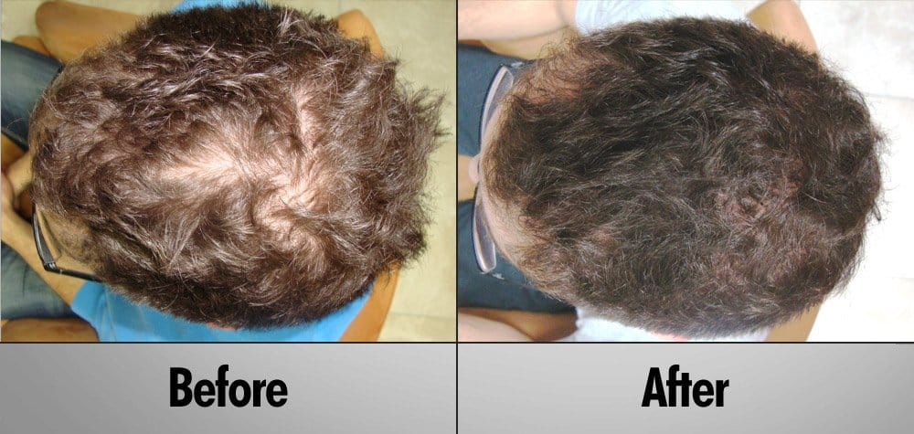 Surehair Patient Matt Before and after clinical laser hair therapy