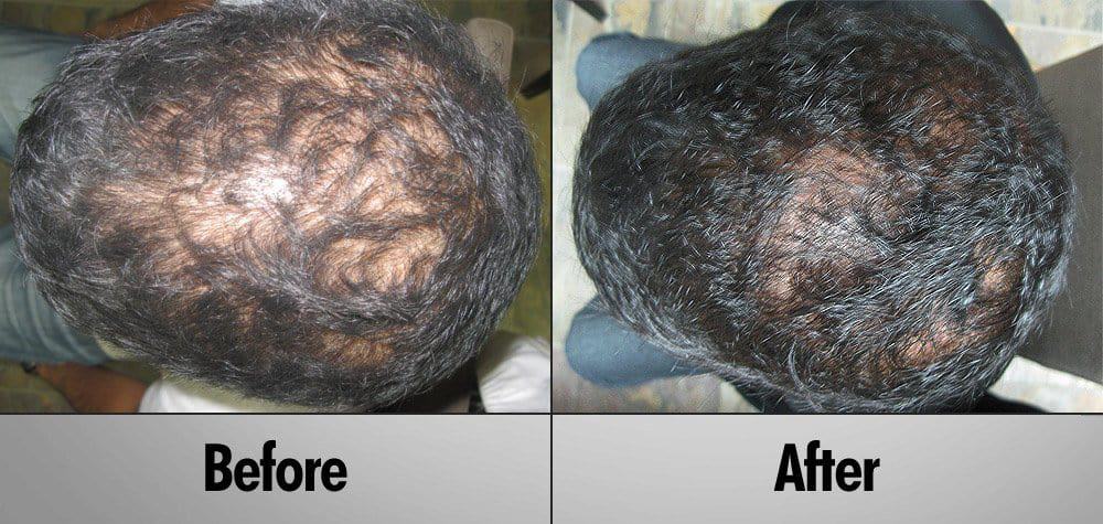 Paul before and after 6 Months of laser hair therapy treatment