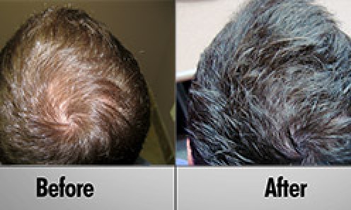 Male Laser Hair Treatment - Patient Ryan