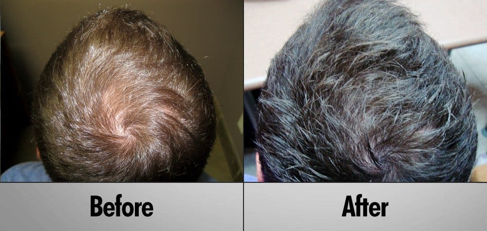 Ryan Before and after 3 Months Laser Hair therapy treatment