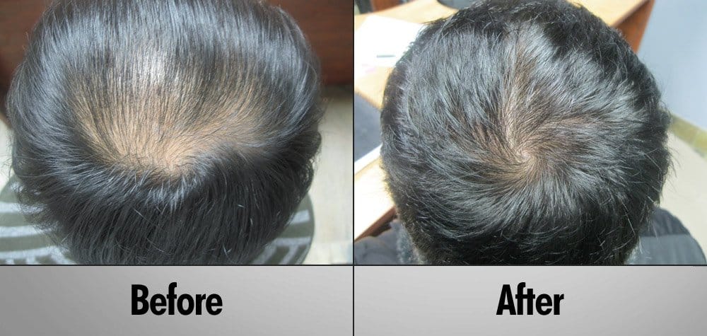 Sam laser hair therapy regrowth treatment patient