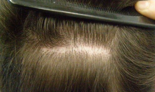 Transplanting Hair into Scars, Scalp Reductions, Bad Scars from accidents, facelifts etc