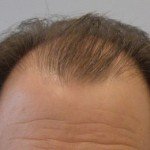 Hairline-before-300x190