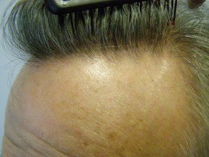 After - Hair Transplant Repair 9 Months Post-Op