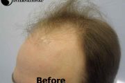 Before and After Hair Transplants 2