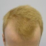 early-hair-loss-pattern.1-300x173 (1)