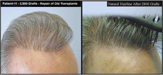 Before and after of Hair Transplant repair of old plugs