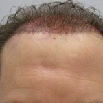 hairline-after-surgery-300x163