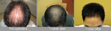 pre and post hair transplant results