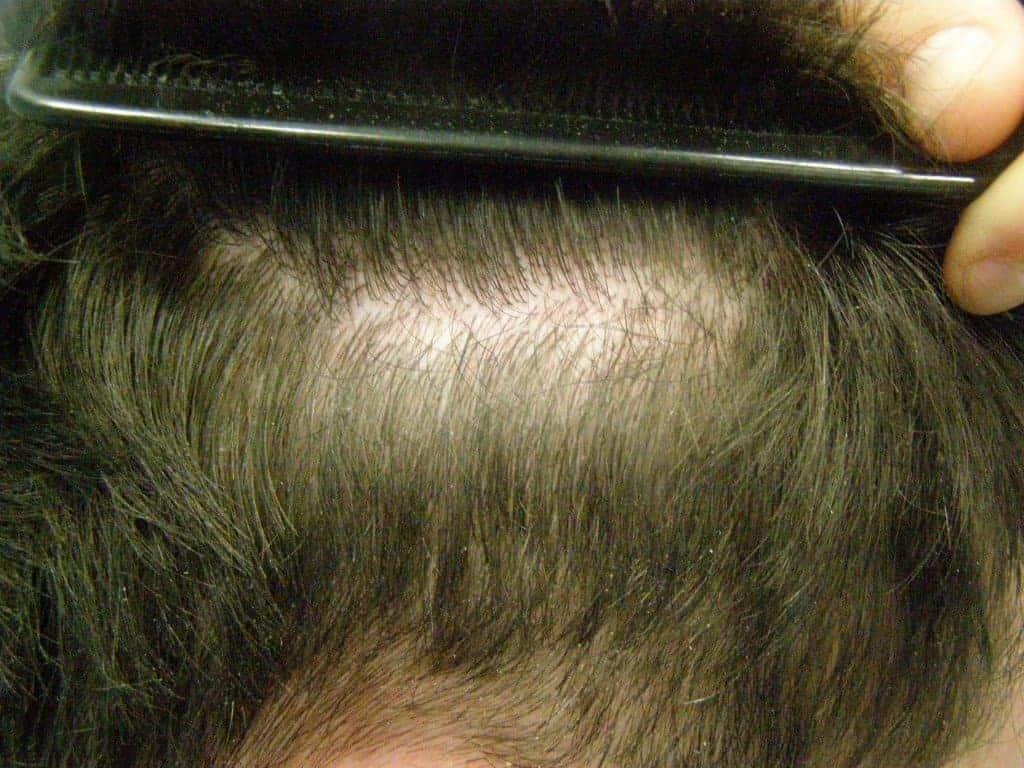 uni-stran-scar-with-hair-growing-through-scar-1024x768