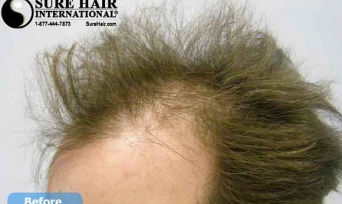 Hair Transplants Before & After Photos continued...